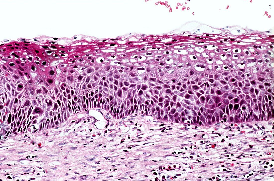 Grade 1 cervical cancer,light micrograph