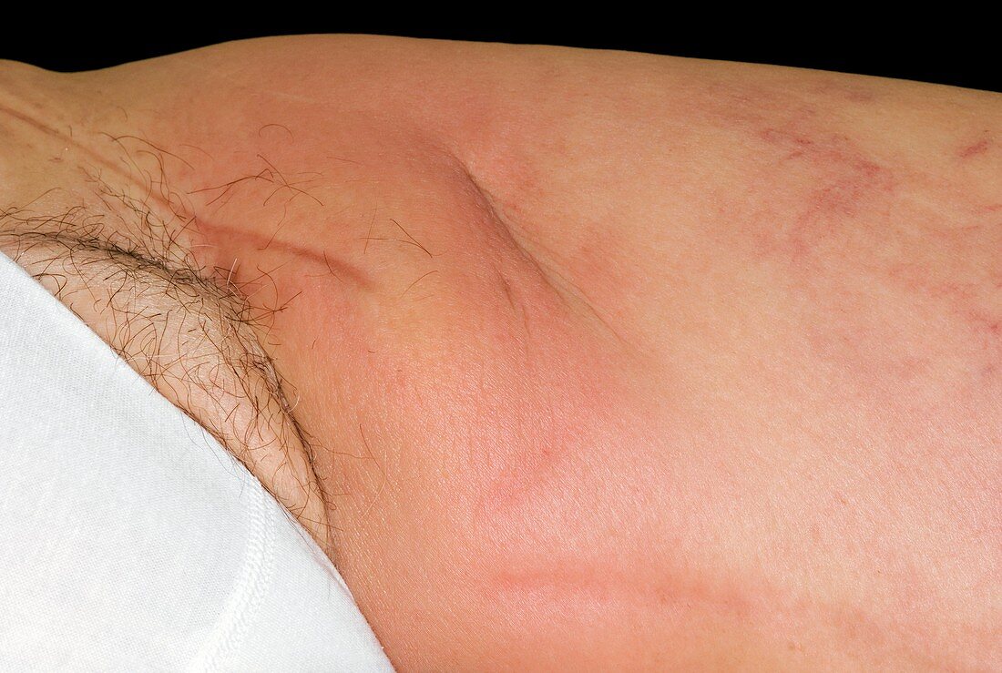 Cellulitis of the thigh