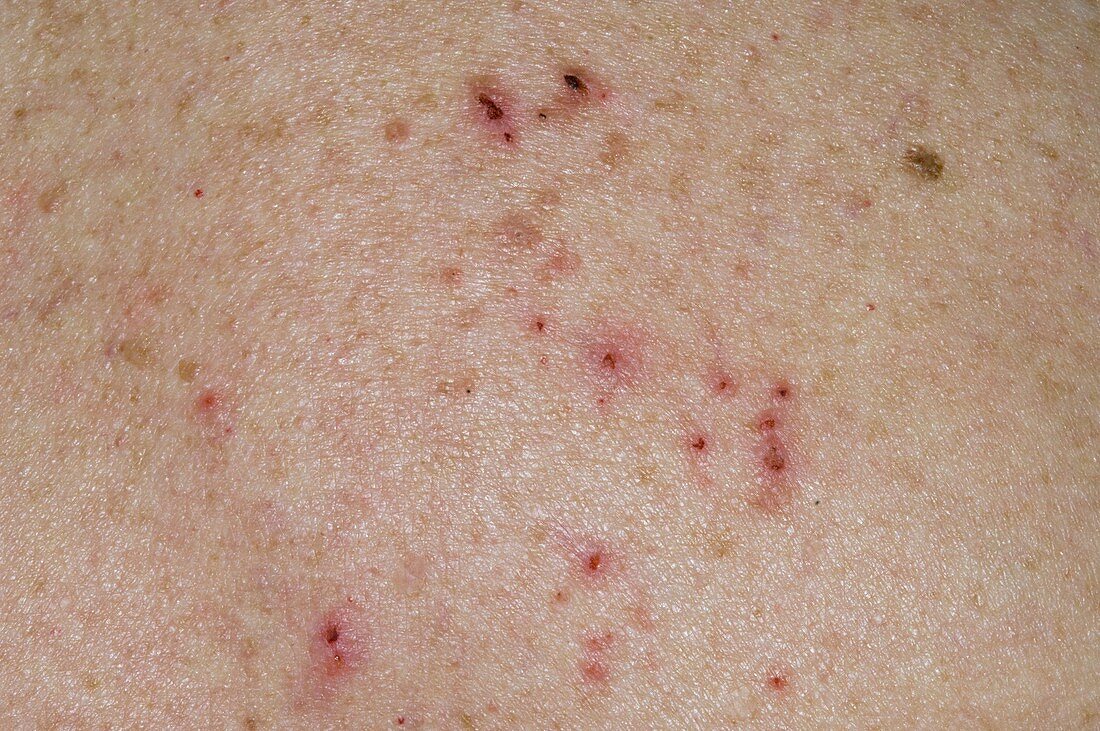 Atopic eczema with scratch marks