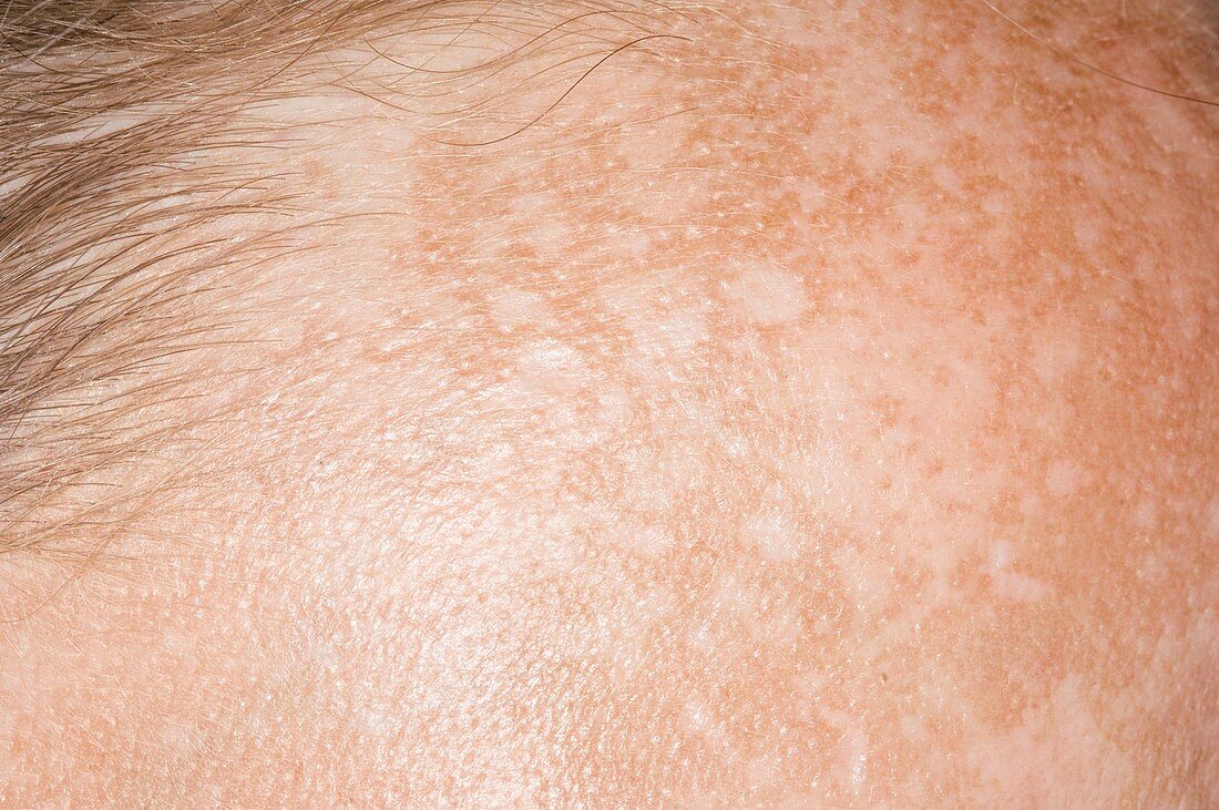 Chloasma skin patches