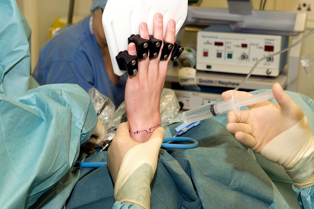 Anaesthetic in arthroscopic wrist surgery