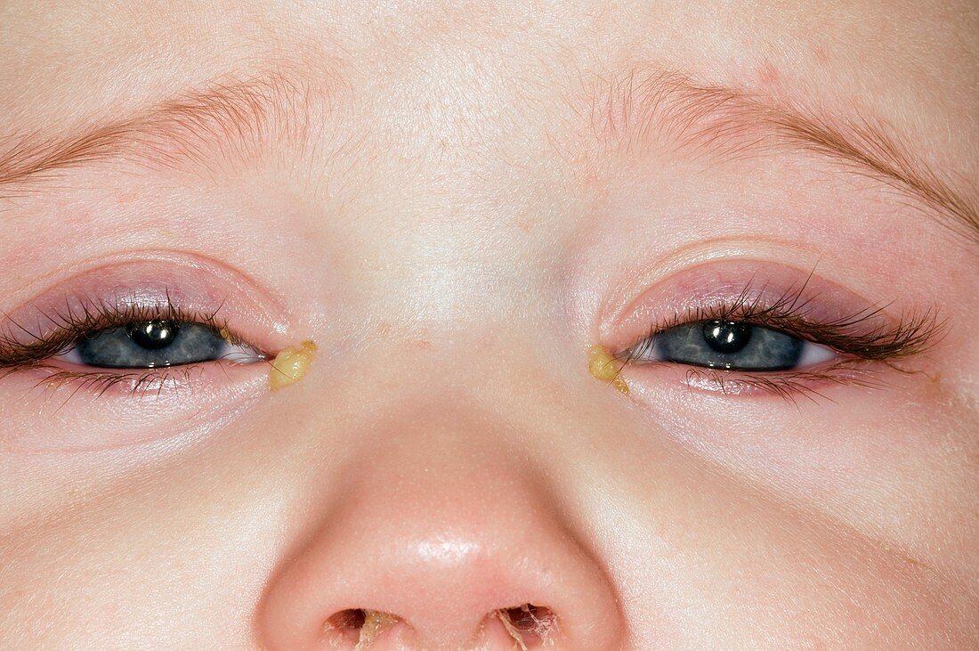Viral conjunctivitis in a child
