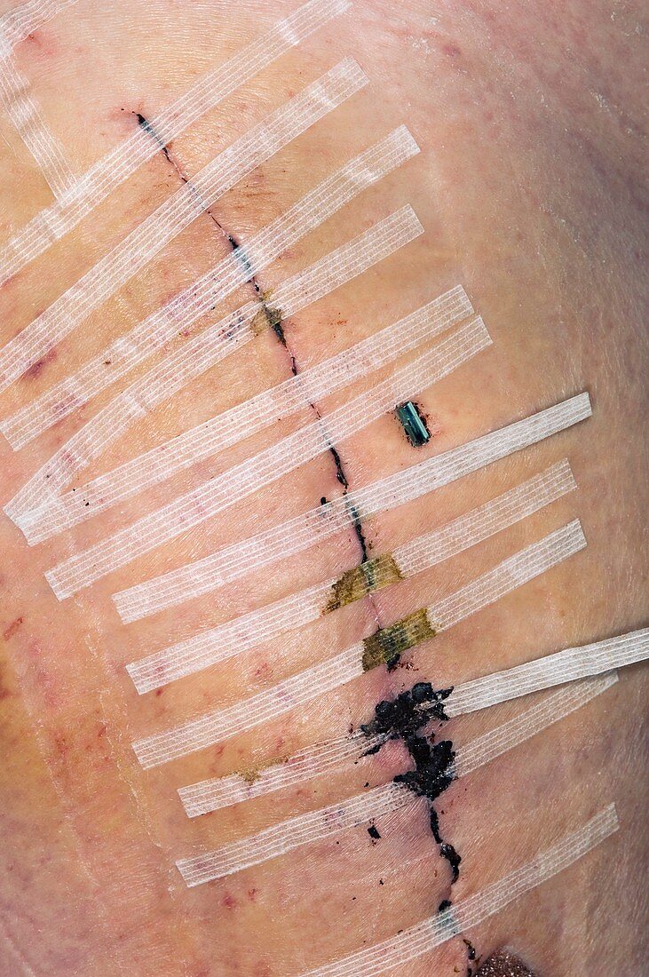 Steri-strips on wound