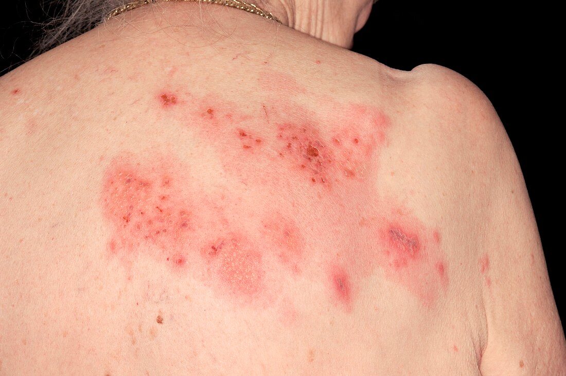 Shingles rash on the back