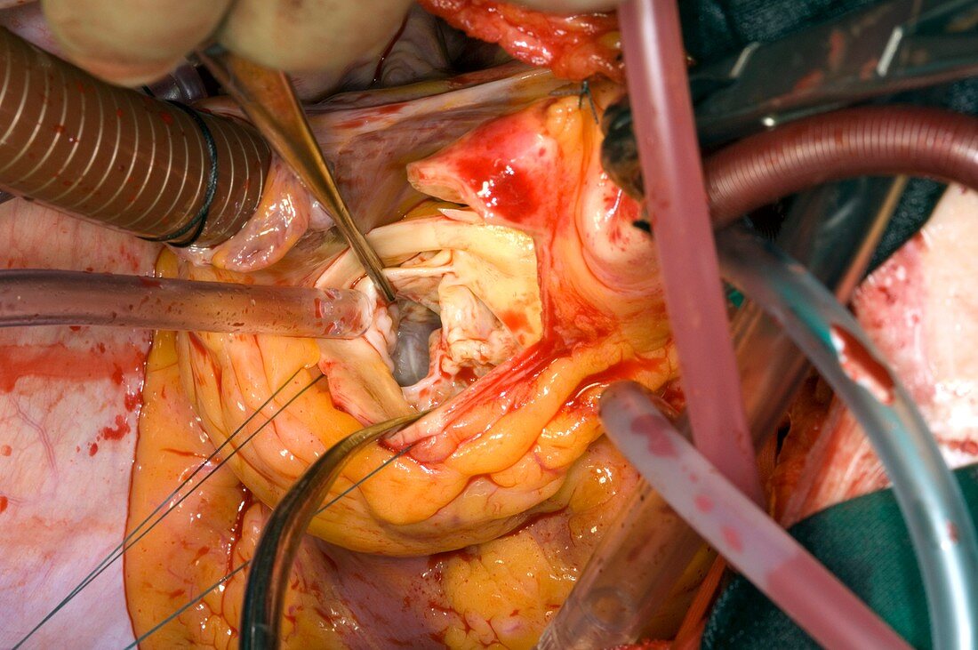 Aortic valve replacement surgery
