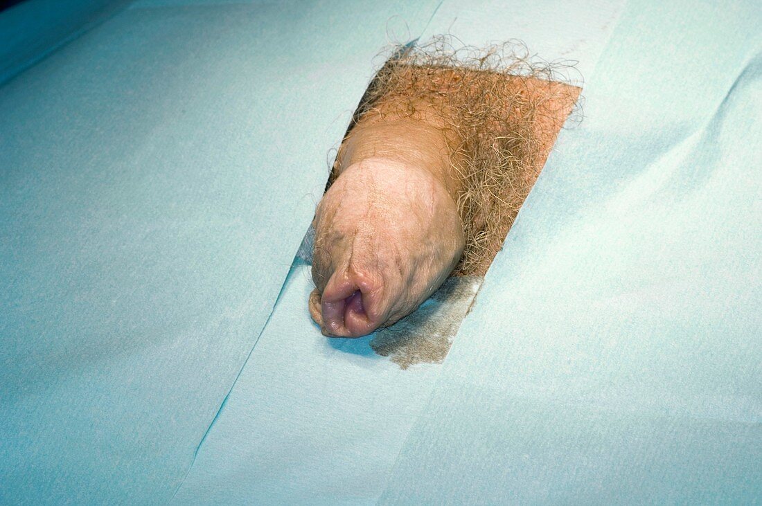Penis with phimosis before circumcision