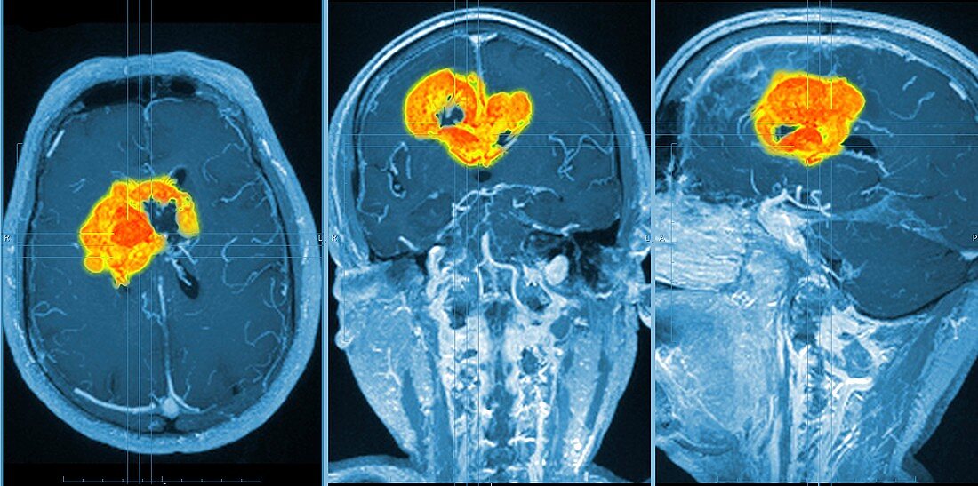 Brain tumour,MRI scan