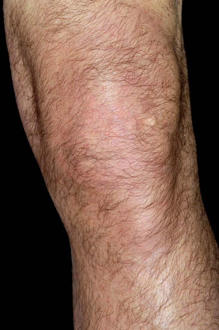 Swollen joint of the knee after a fall