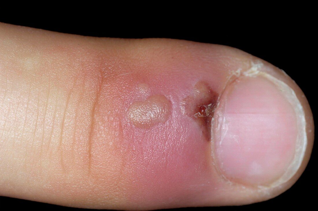 Paronychia of fingernail