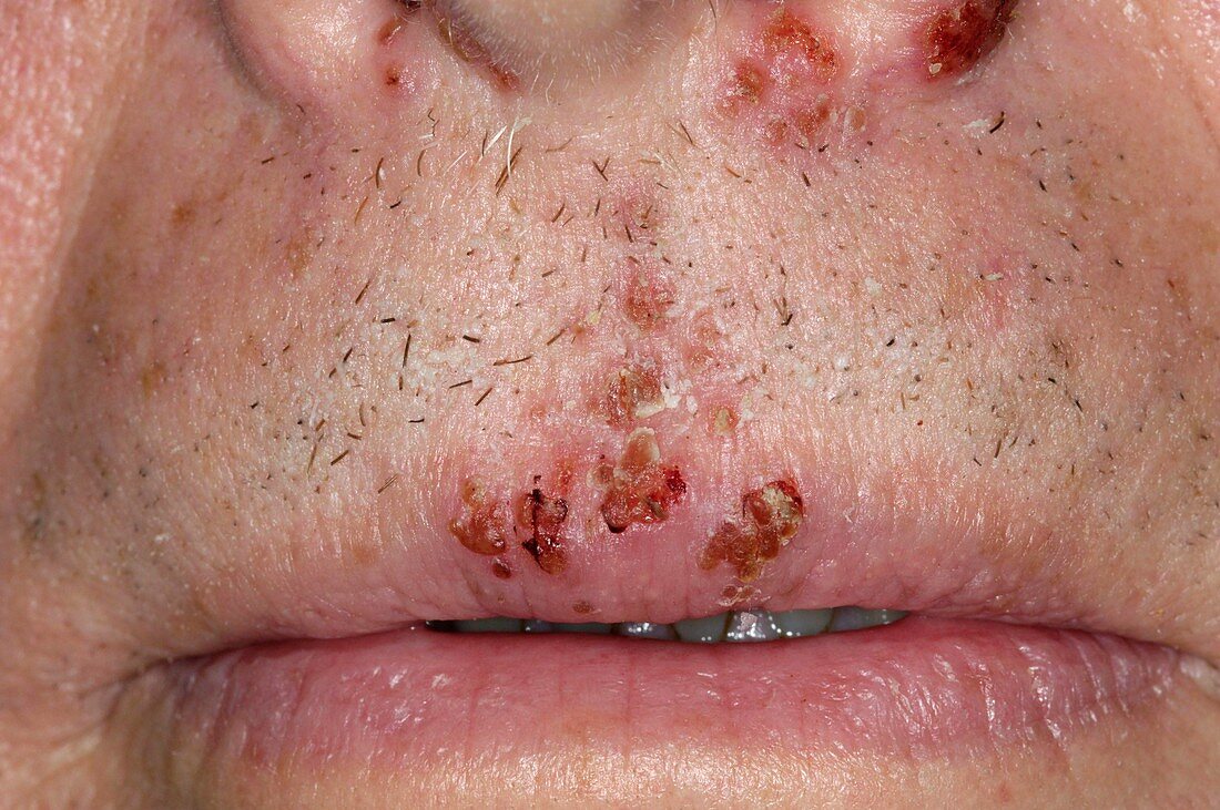Cold sores on the upper lip