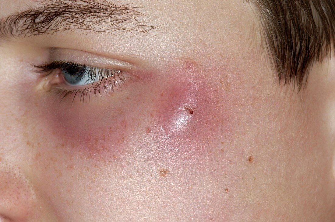 Infected insect bite on the cheek