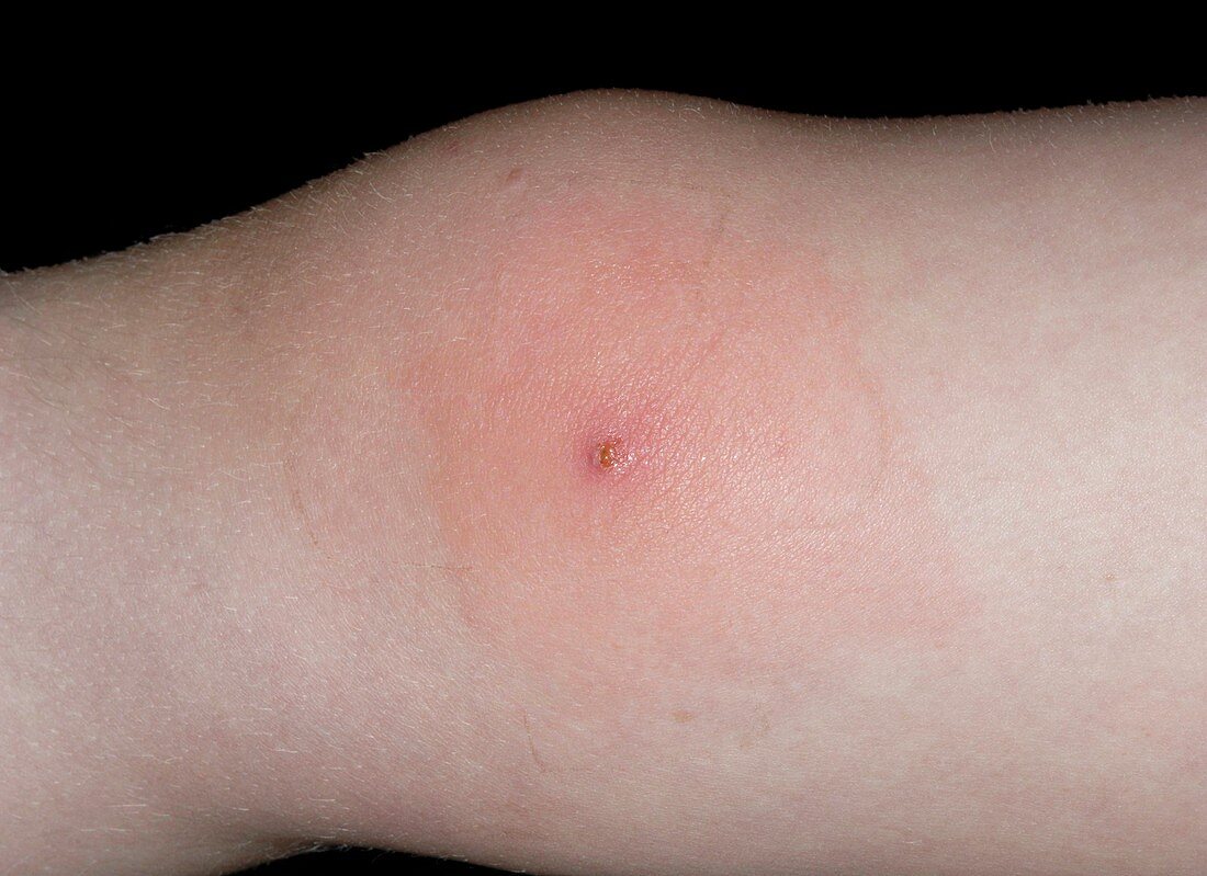 Infected molluscum contagiosum on knee
