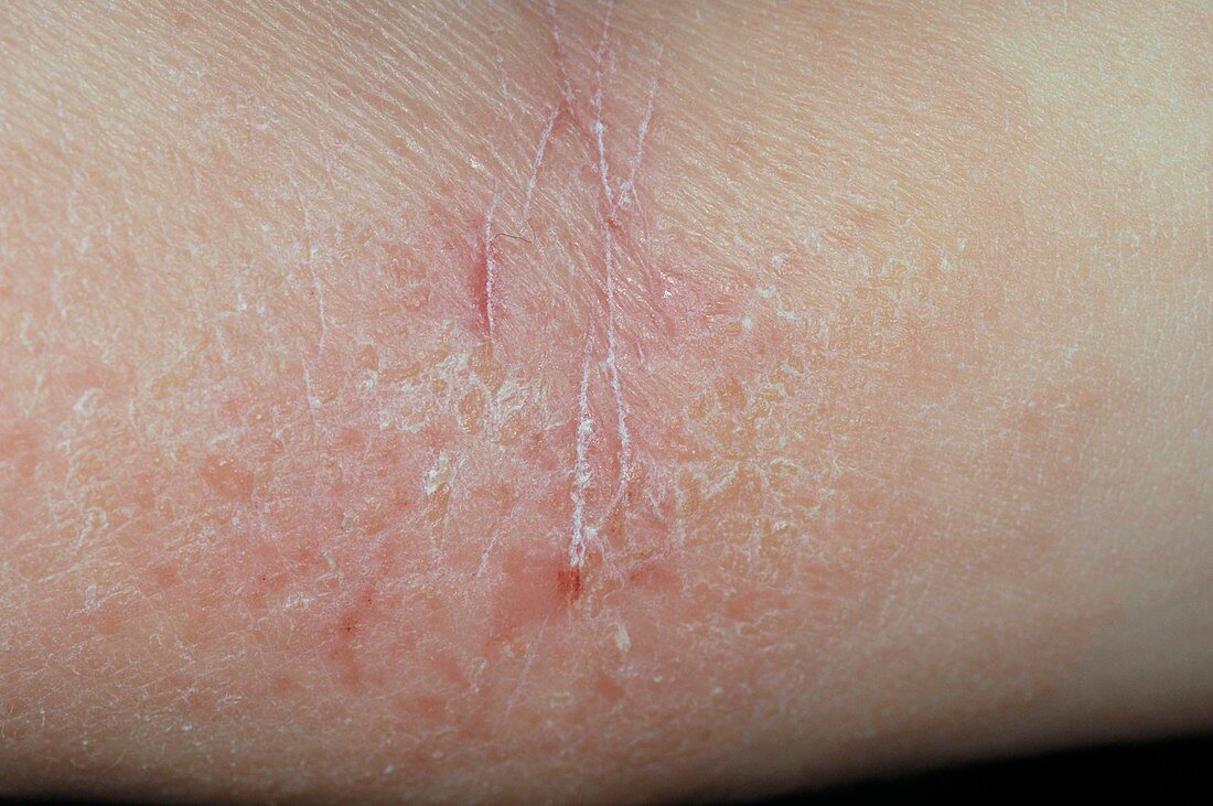 Atopic eczema in a child