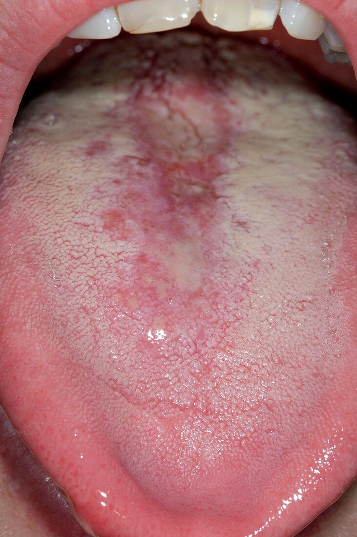 Thrush (Candida) on the tongue