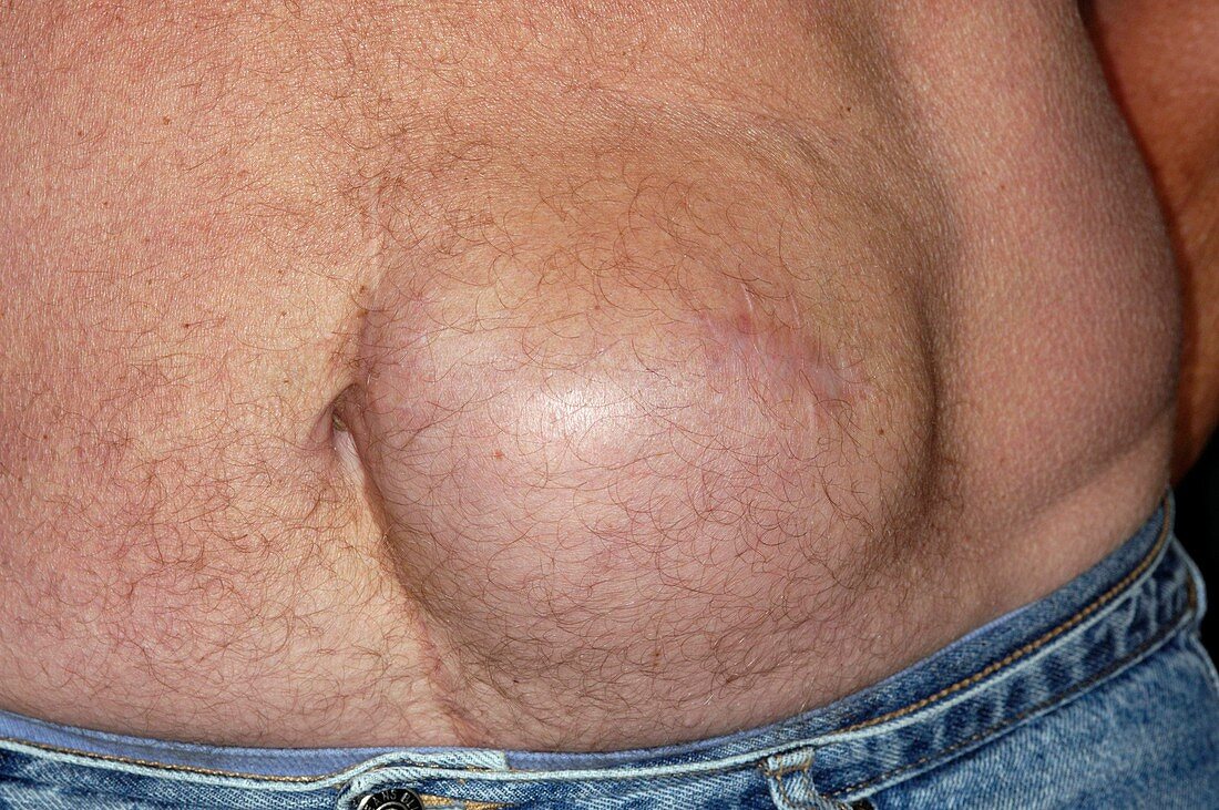 Incisional hernia of the abdomen