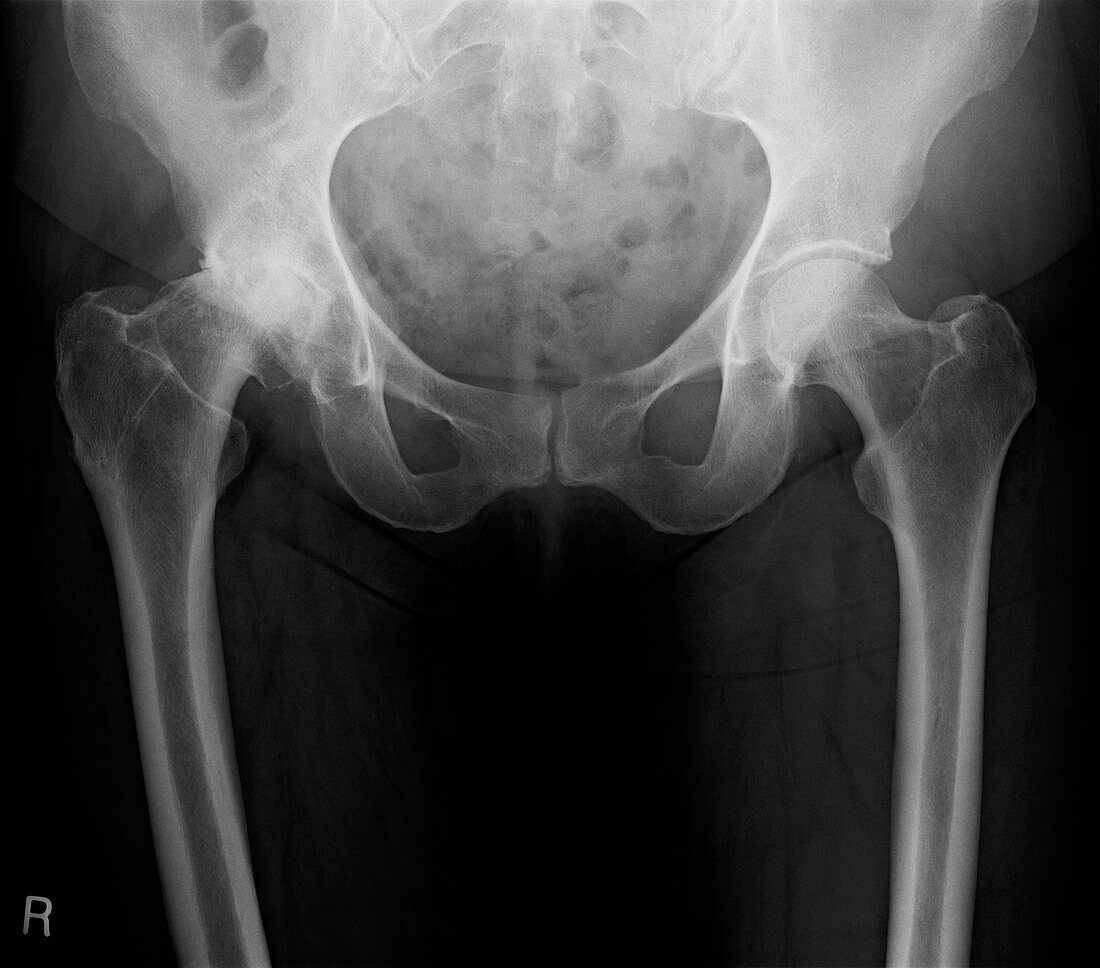 Slipped capital femoral epiphysis,X-ray