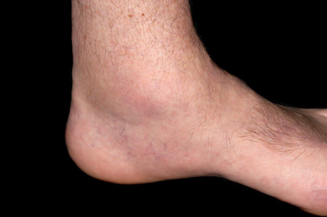 Gout of the ankle