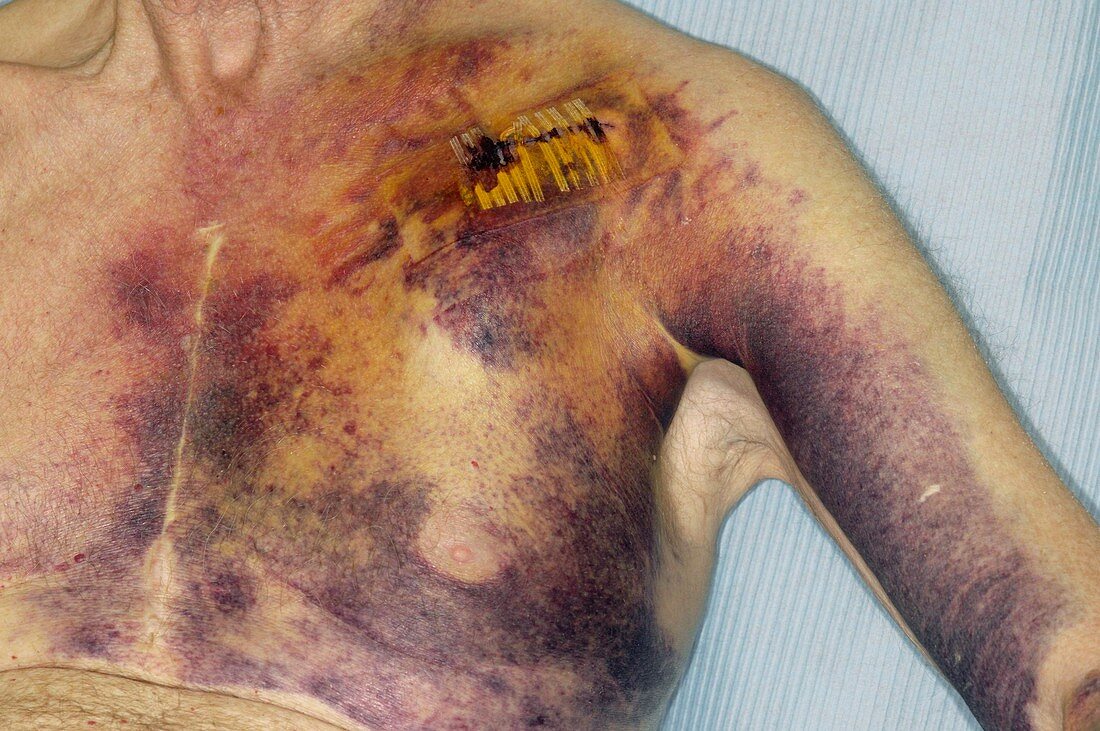Bruising from heart ICD implant