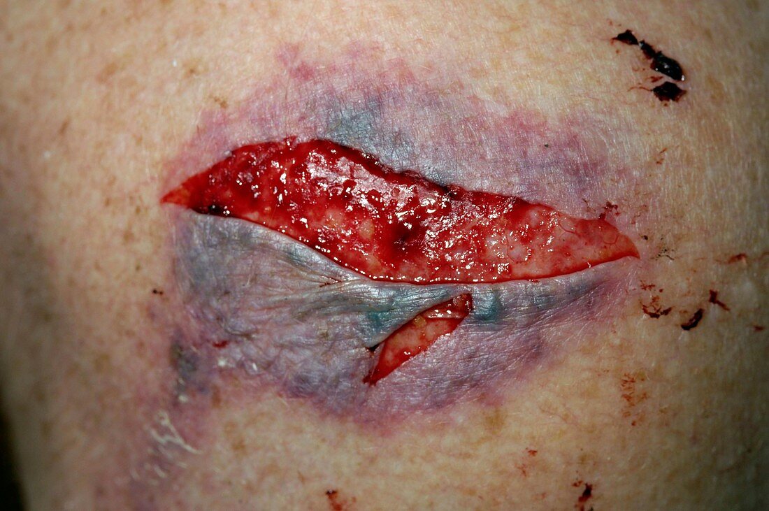 Shoulder wound from a fall