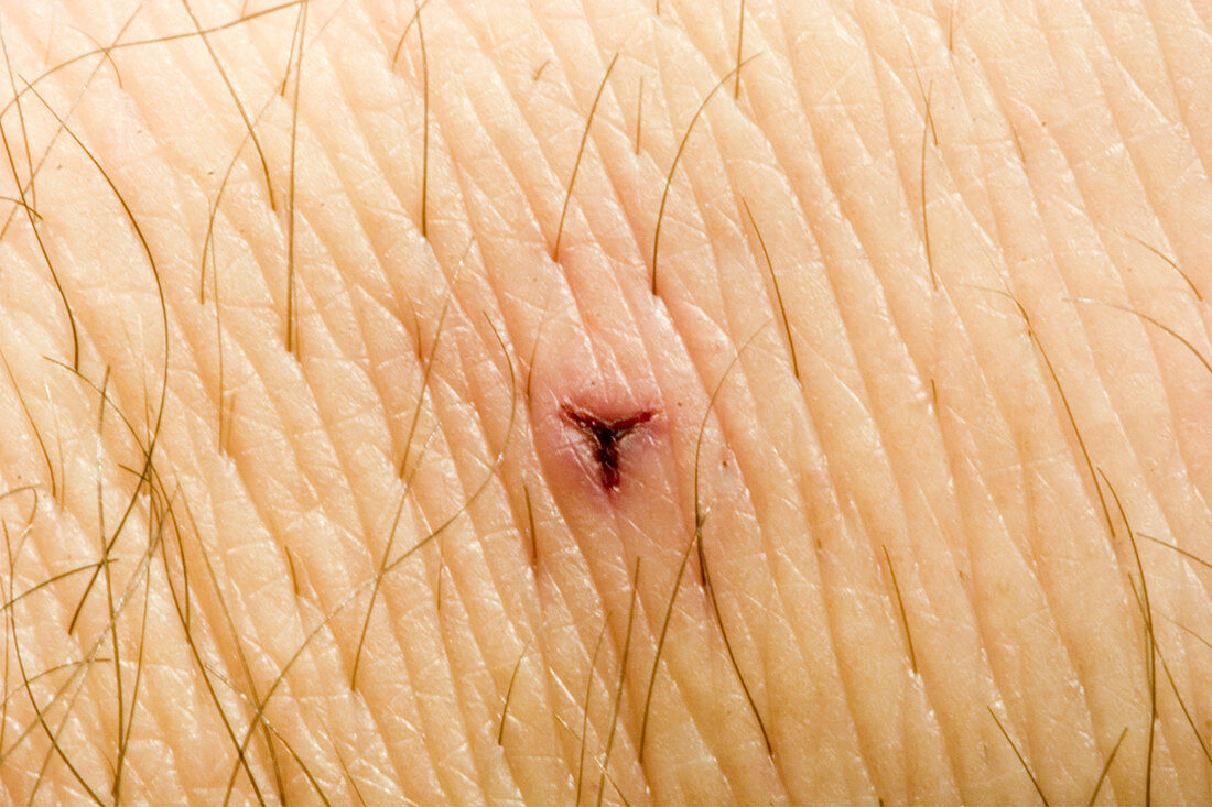 Bite on human skin from Medicinal Leech