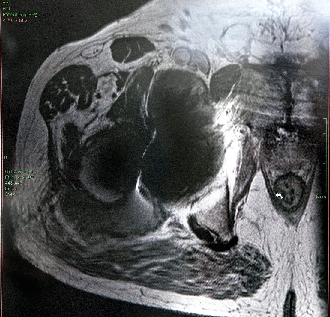 Failed hip replacement,MRI scan