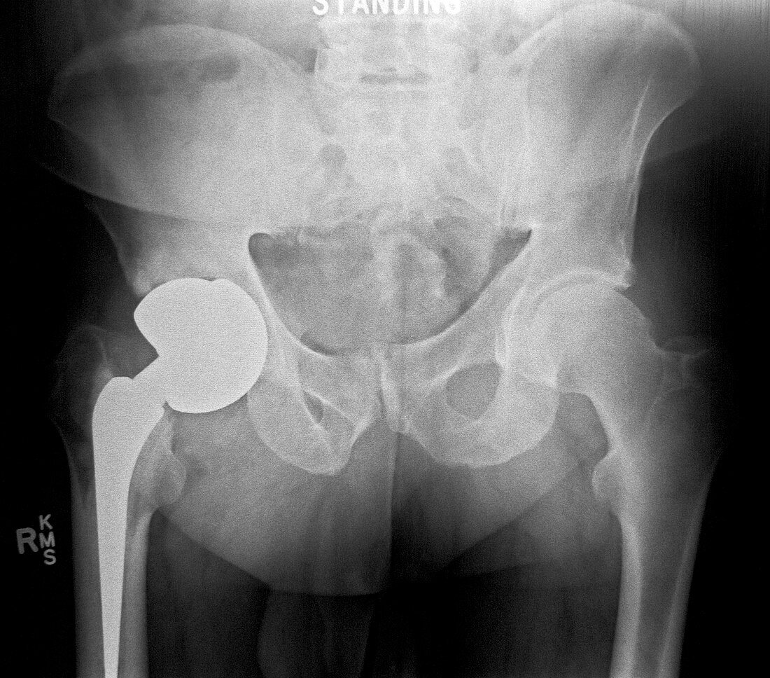 Failed hip replacement,X-ray