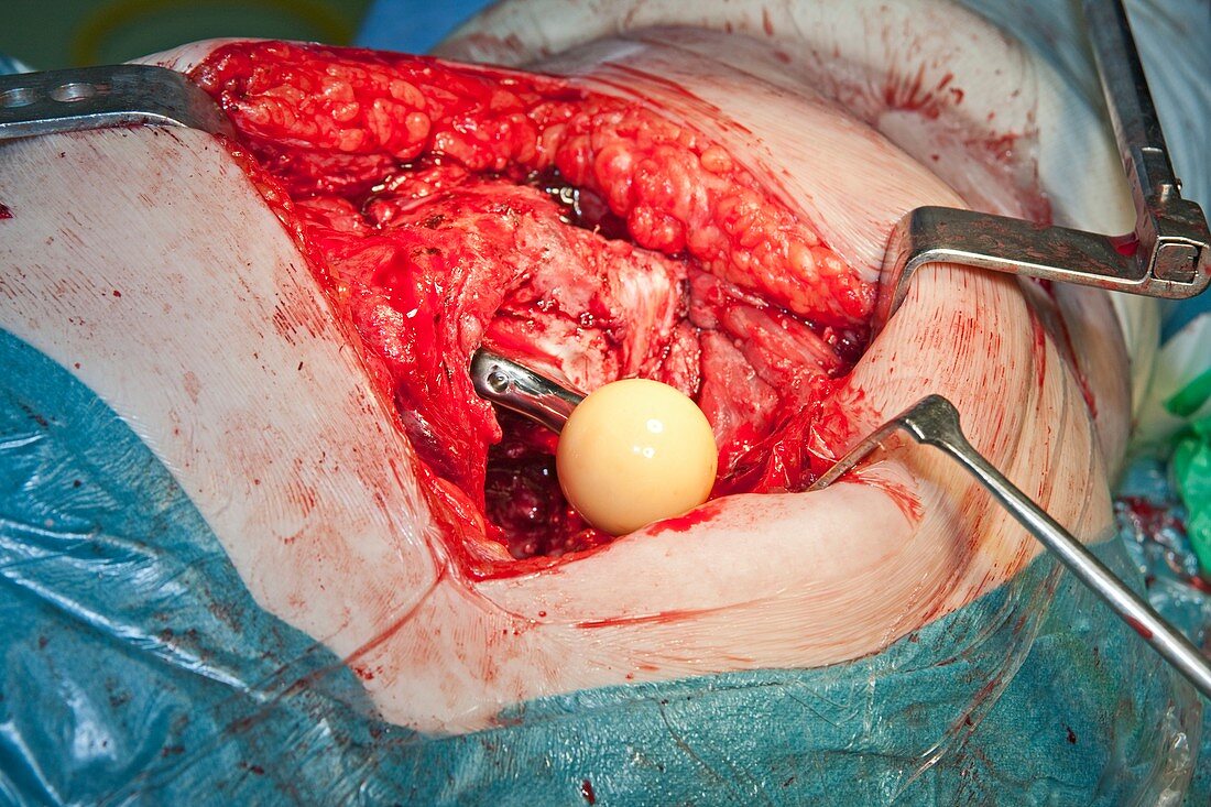 Failed hip replacement surgery