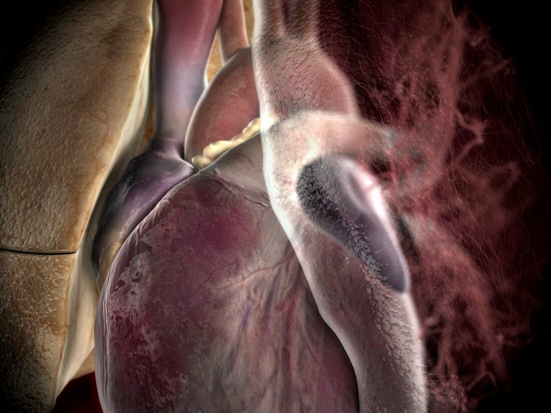 Heart fibrosis,artwork
