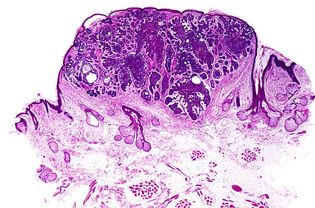 Pyogenic granuloma,light micrograph