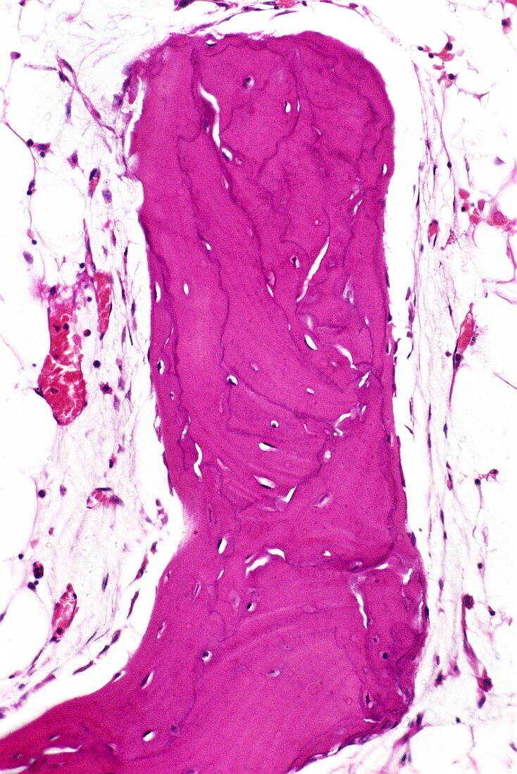 Paget's disease,light micrograph