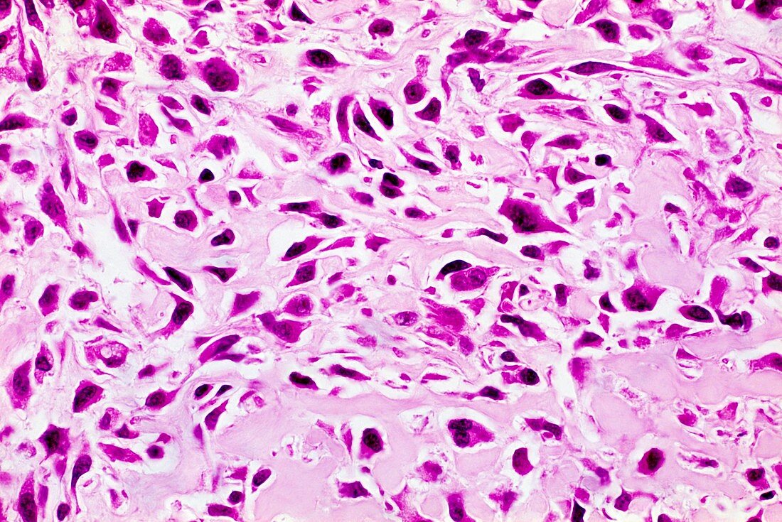 Bone cancer,light micrograph