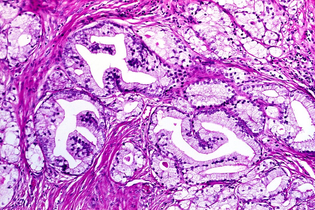 Prostate hyperplasia,light micrograph