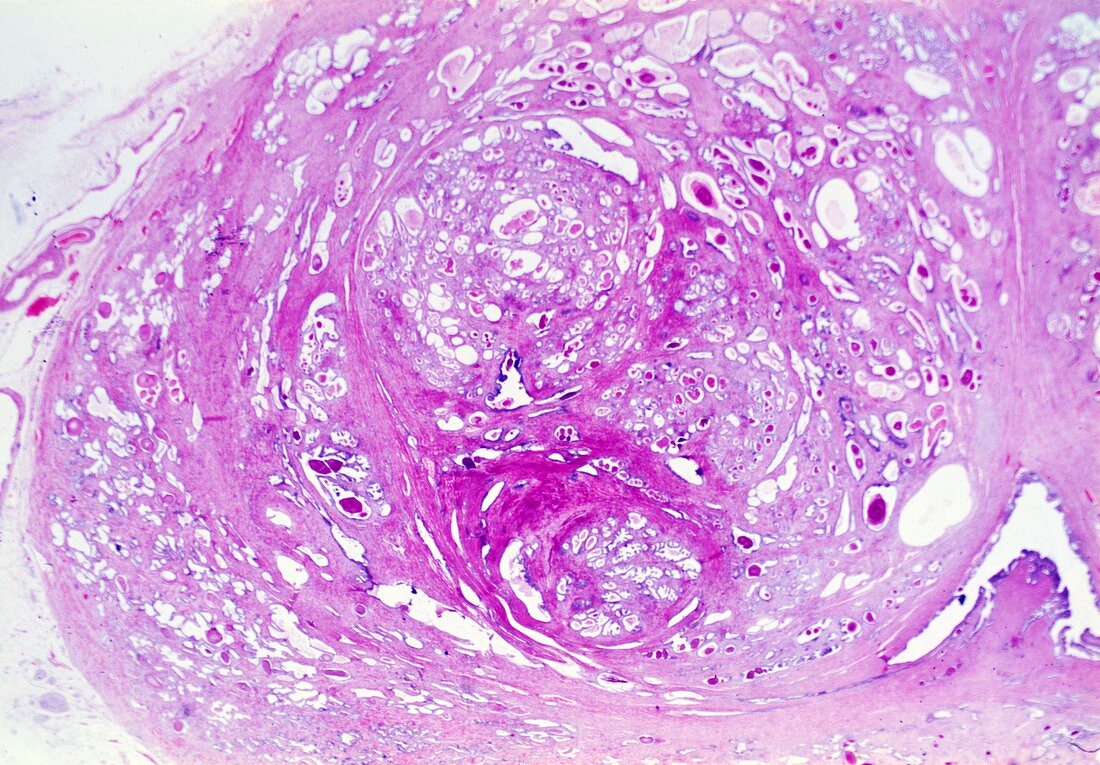 Prostate hyperplasia,light micrograph