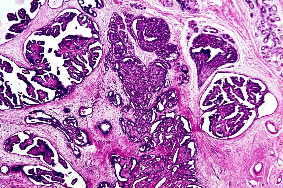 Breast fibroadenoma,light micrograph