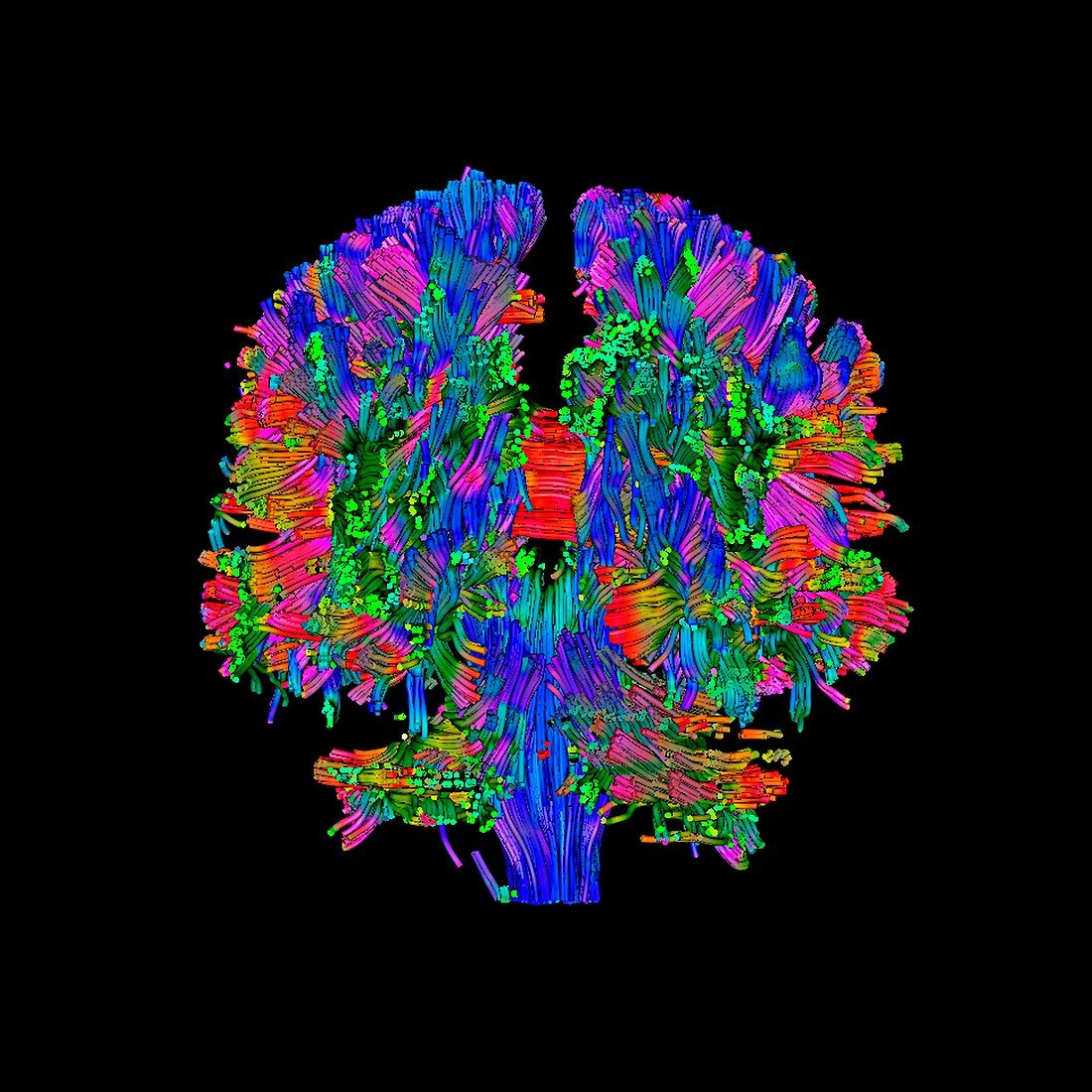 Brain tumour,DTI scan