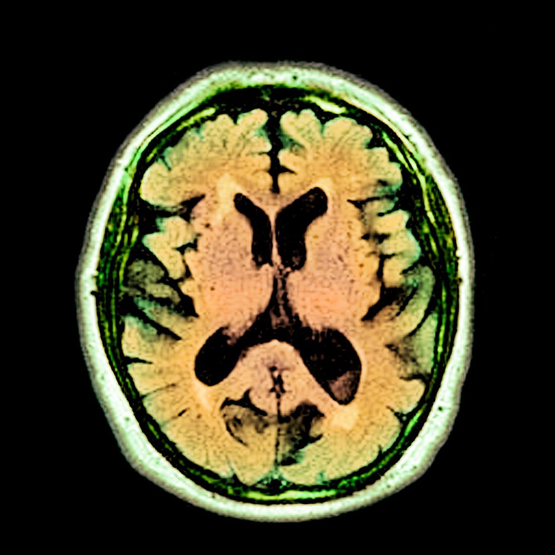 Alcoholic dementia,MRI scan