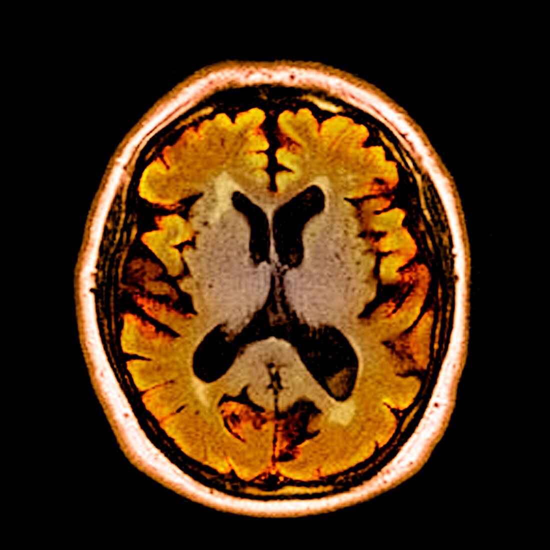 Alcoholic dementia,MRI scan