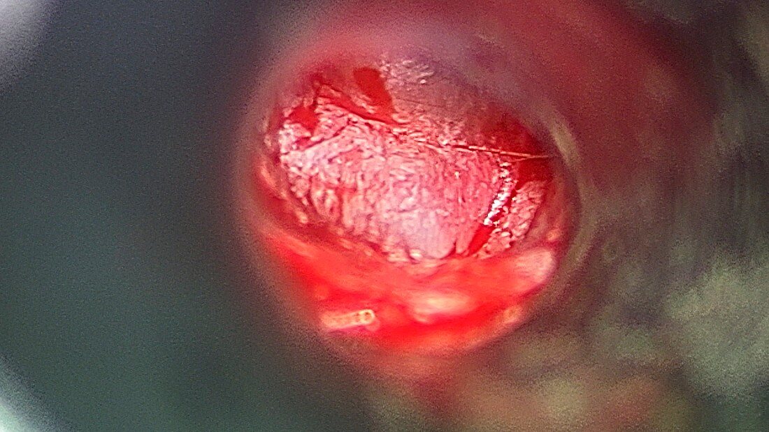 Middle ear surgery,endoscope view