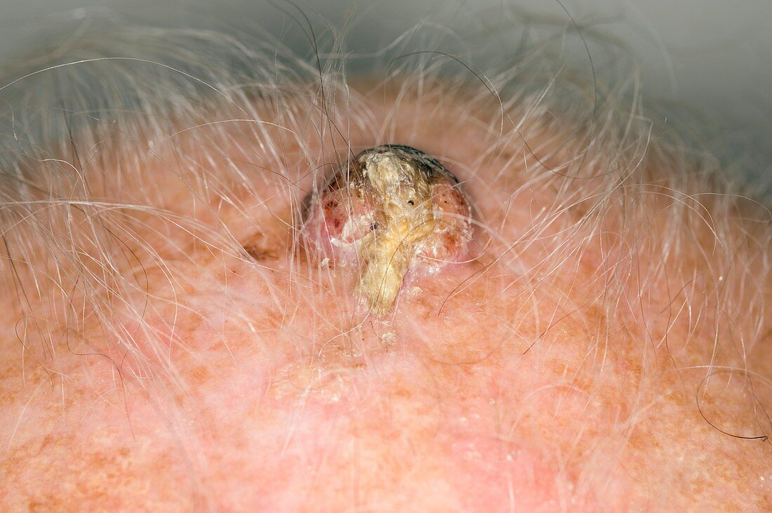 Squamous cell cancer on the scalp
