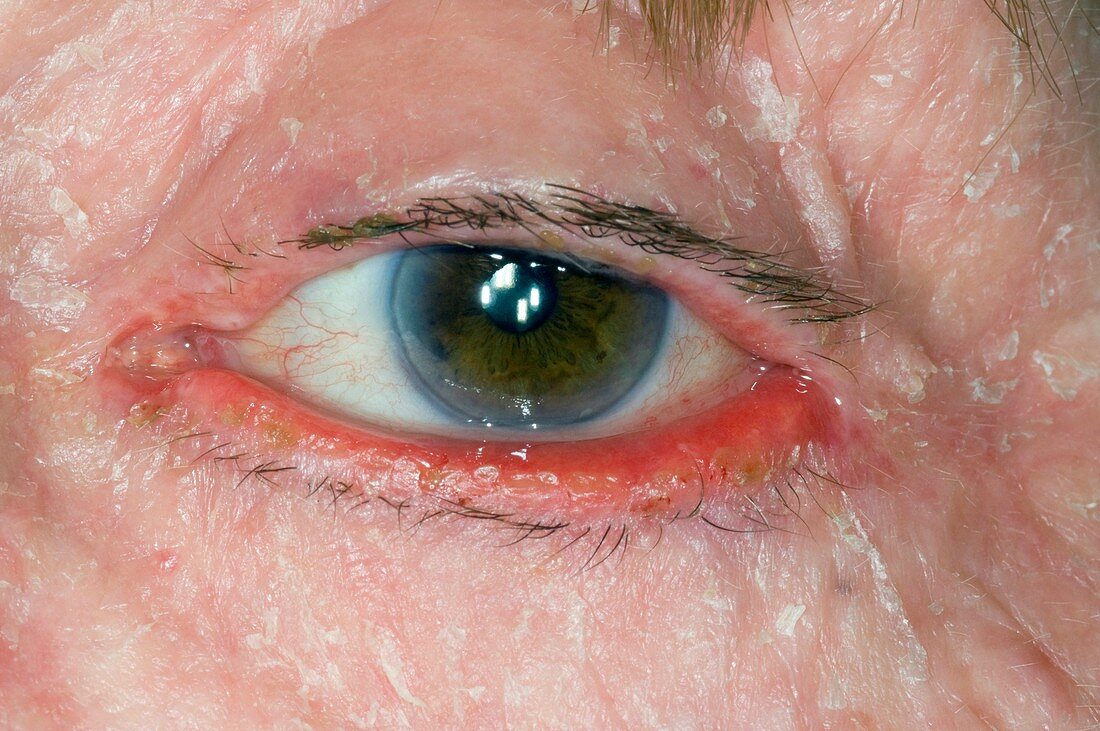 Ectropion of eye with facial eczema