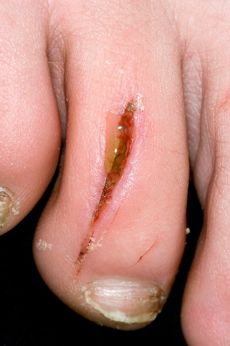 Laceration on the toe
