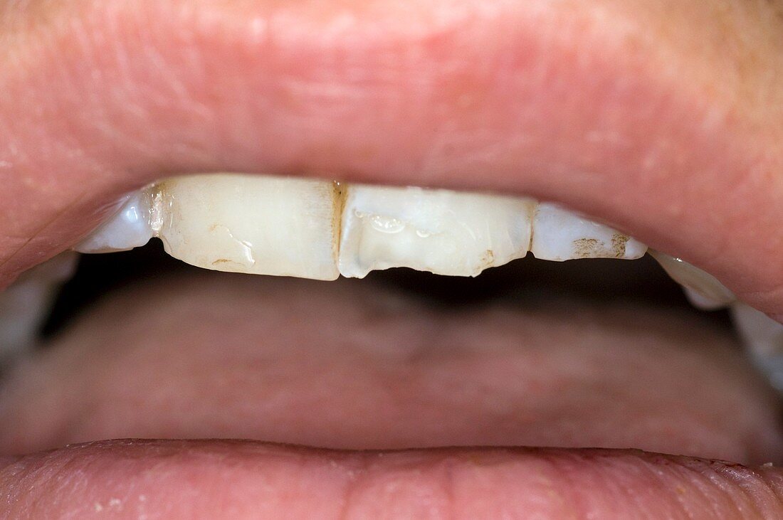 Chipped tooth after a fall