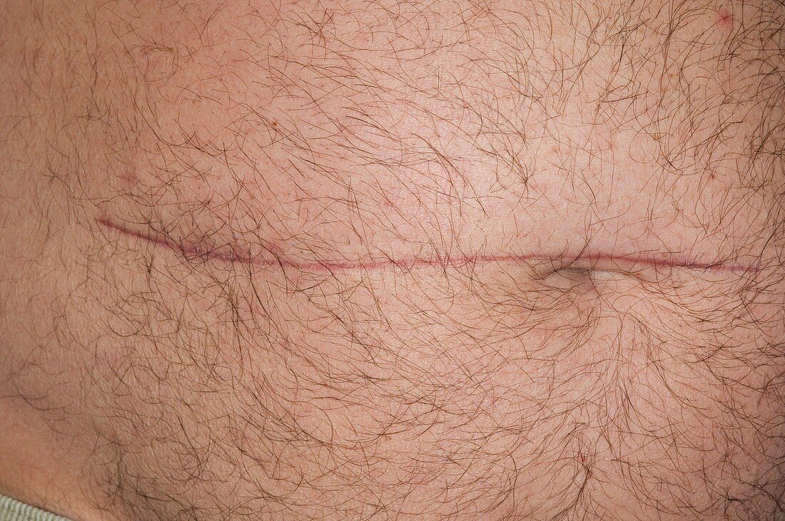 Scar on abdomen to treat colon cancer