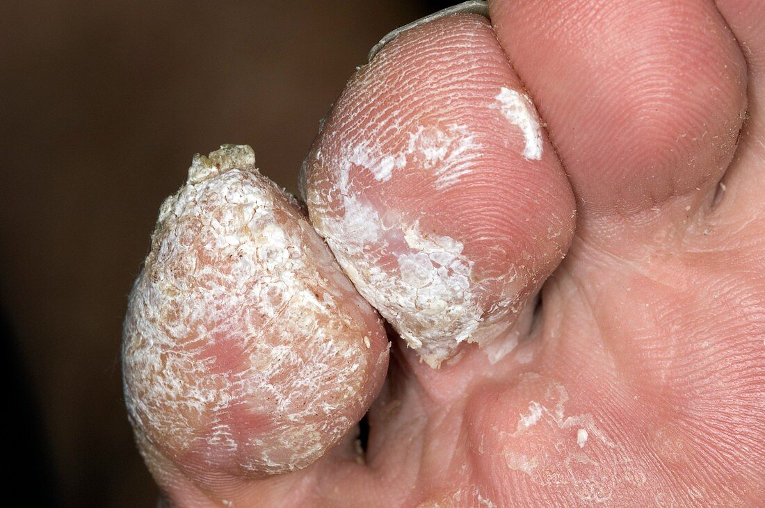 Chronic warts on the toes