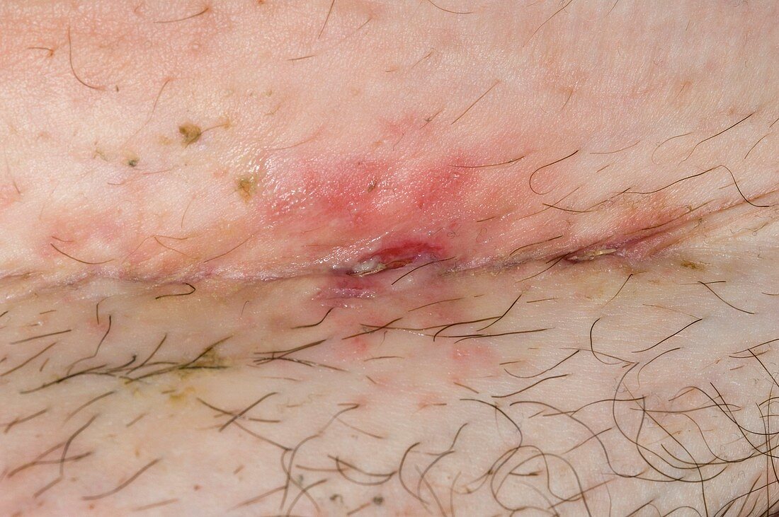 Infected caesarean scar