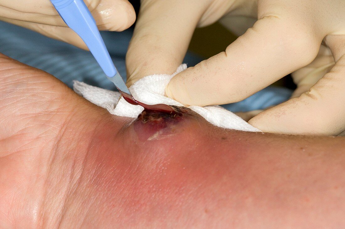 Abscess treatment