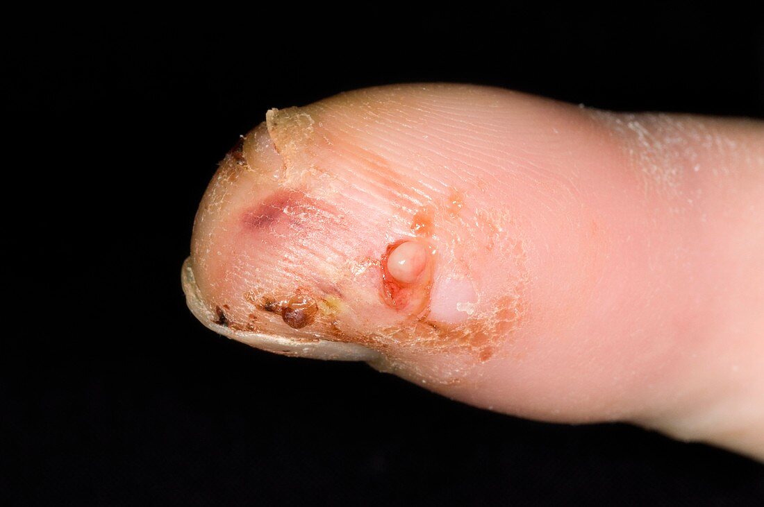 Infected cat bite on the finger