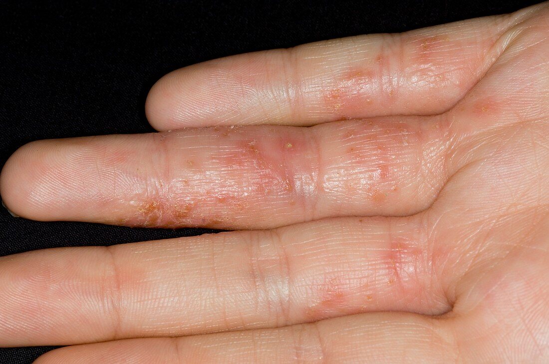 Eczema on the fingers