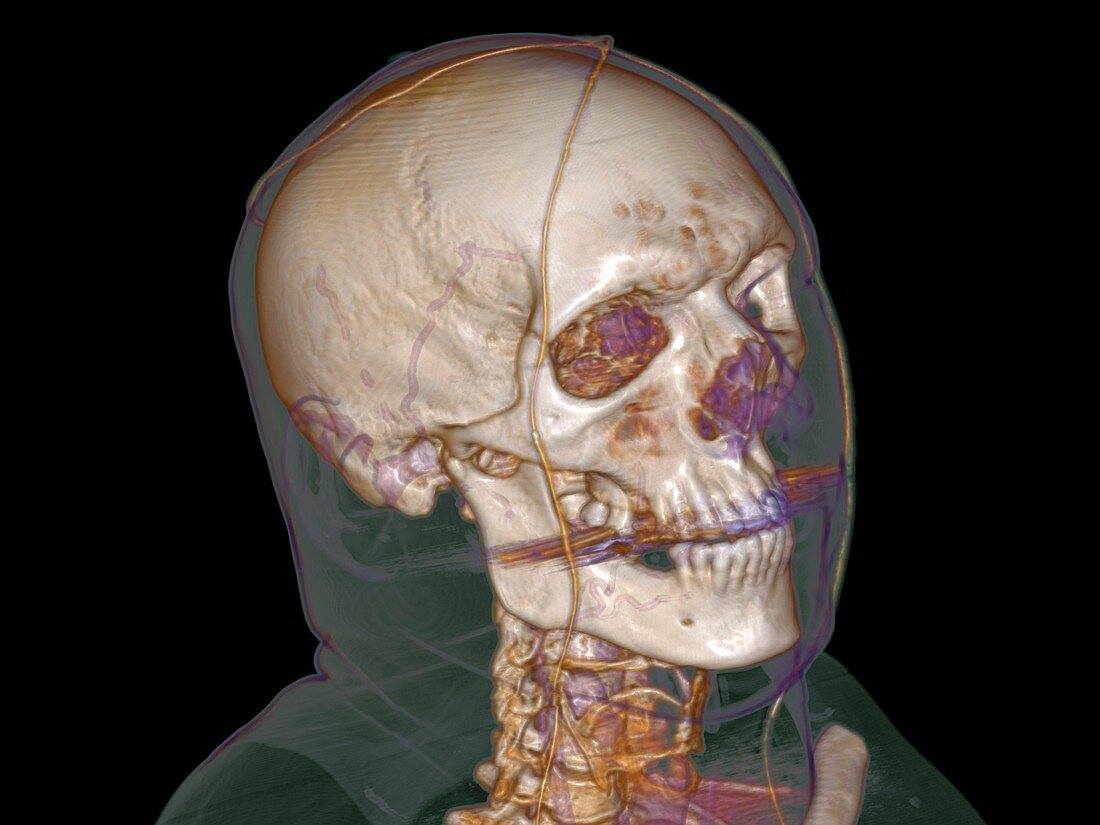 Normal head,3D CT scan