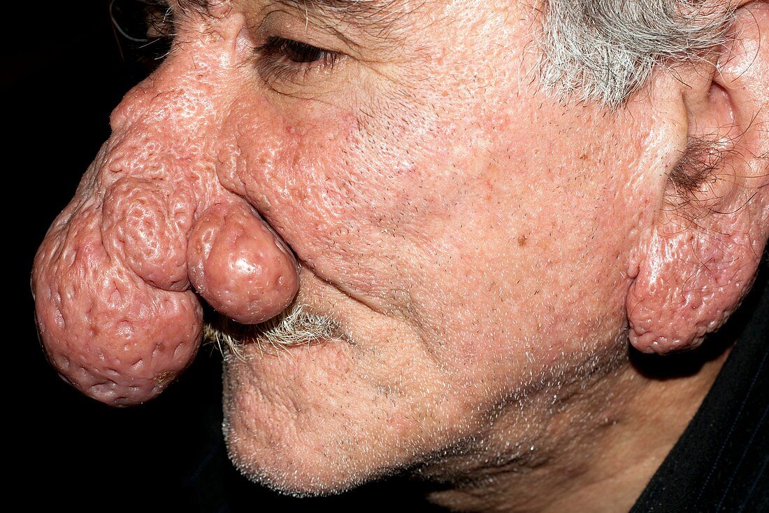 Rhinophyma of the nose and ear